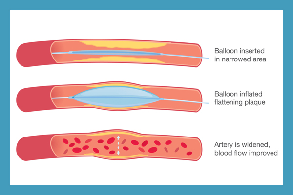 Angioplasty