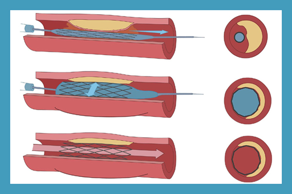 Atherectomy and Stenting