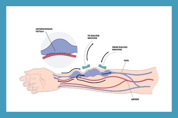 Arteriovenous Fistula Creation for Dialysis Acess