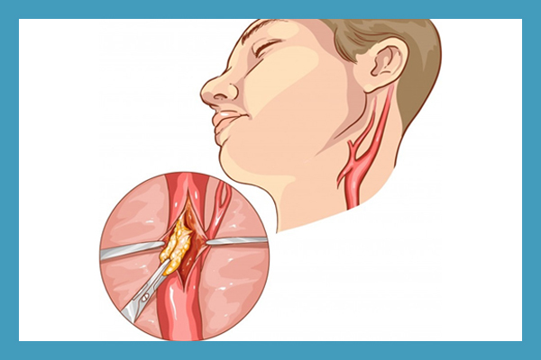 Carotid Endarterectomy