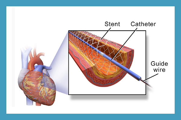Carotid Stenting