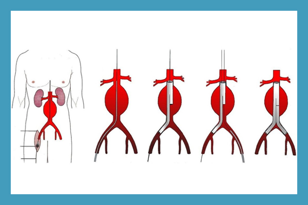 Endovascular Stent Graft