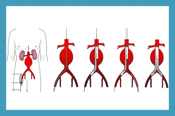 Endovascular Stent Graft