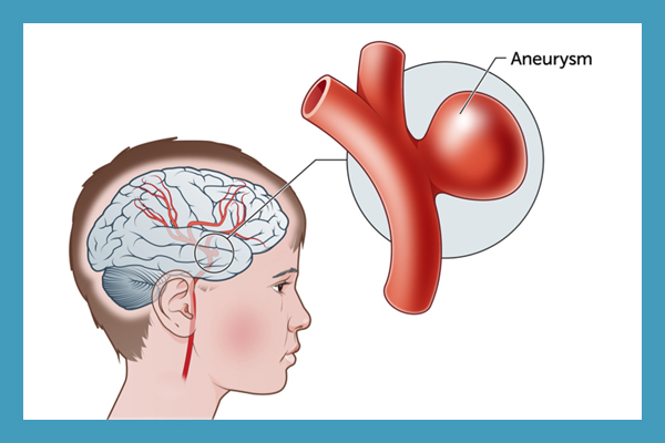 Surgical Aneurysm Repair