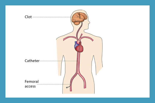 Thrombolytic Therapy