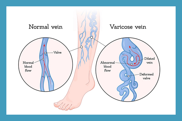 Varicose Veins Treatment